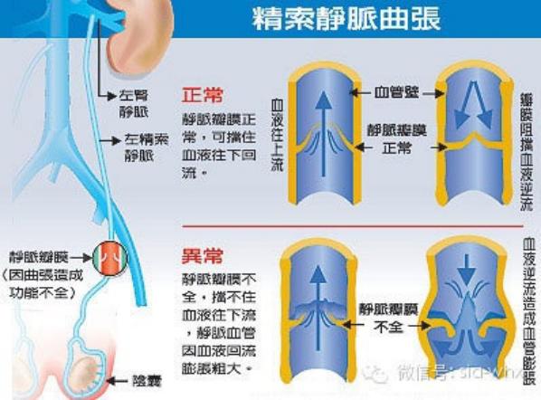 關(guān)于2021年征兵精索靜脈曲張標(biāo)準(zhǔn)的探討，2021年征兵精索靜脈曲張標(biāo)準(zhǔn)深度解析